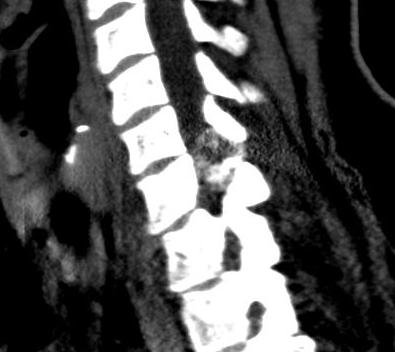 Osteoblastoma Spine0001